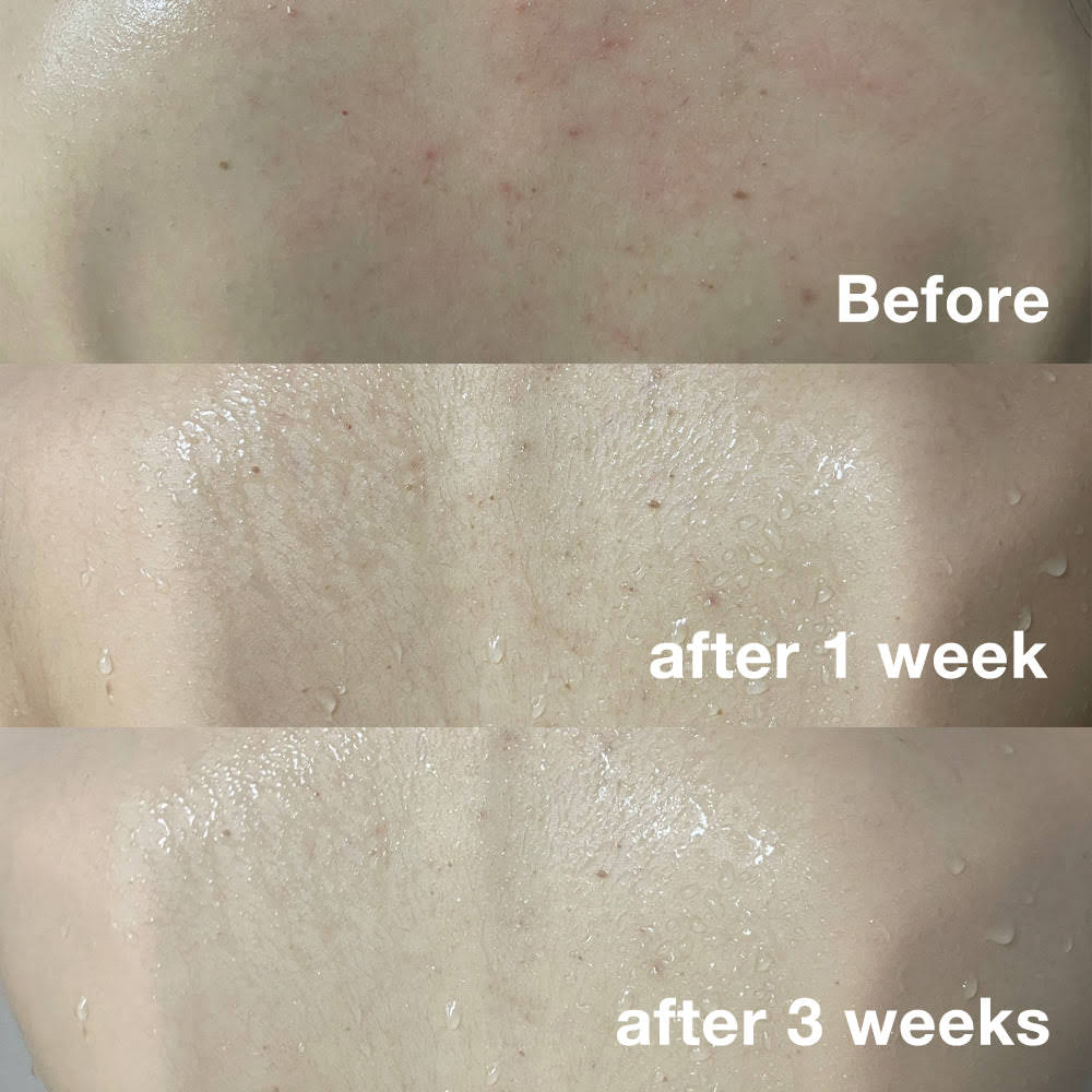 Salicylic Acid Body Wash